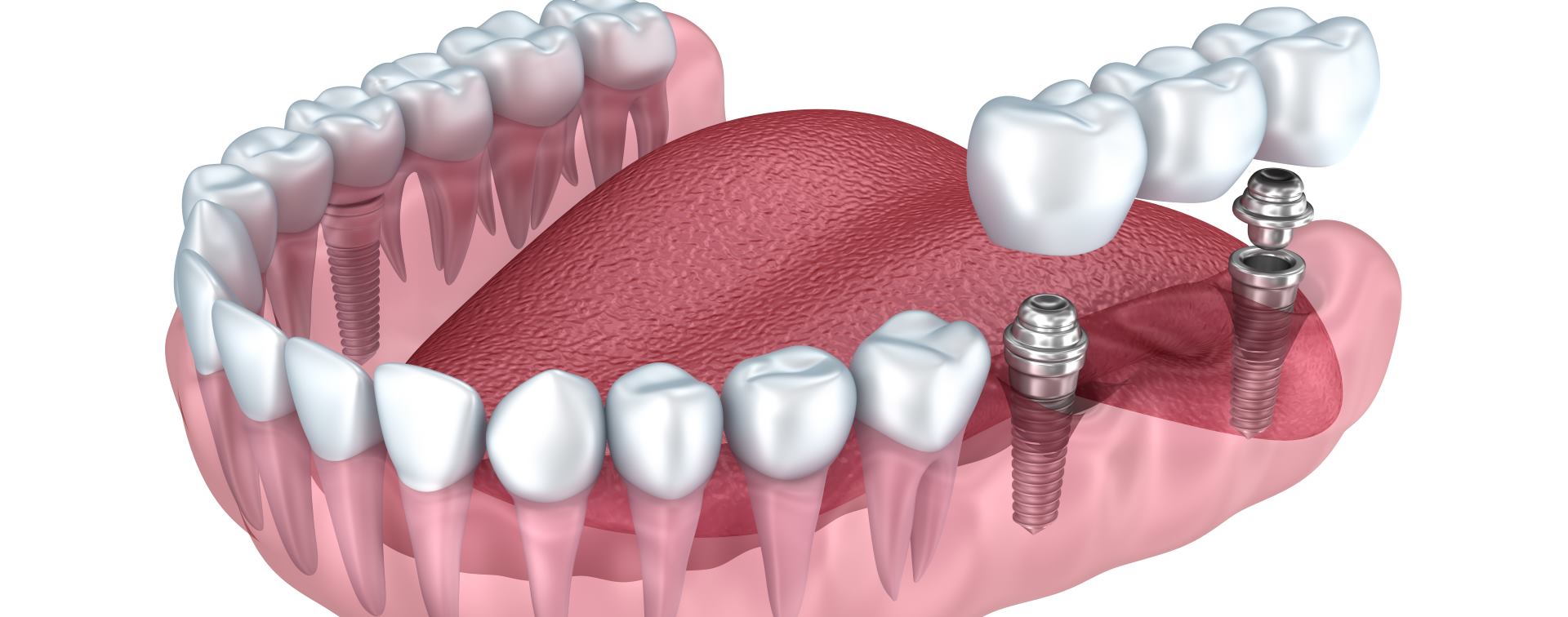 фото имплантов жевательных зубов